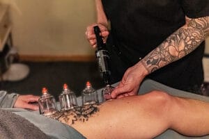 an upper leg receiving cupping therapy